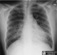 Pneumocystis Pneumonia PCP